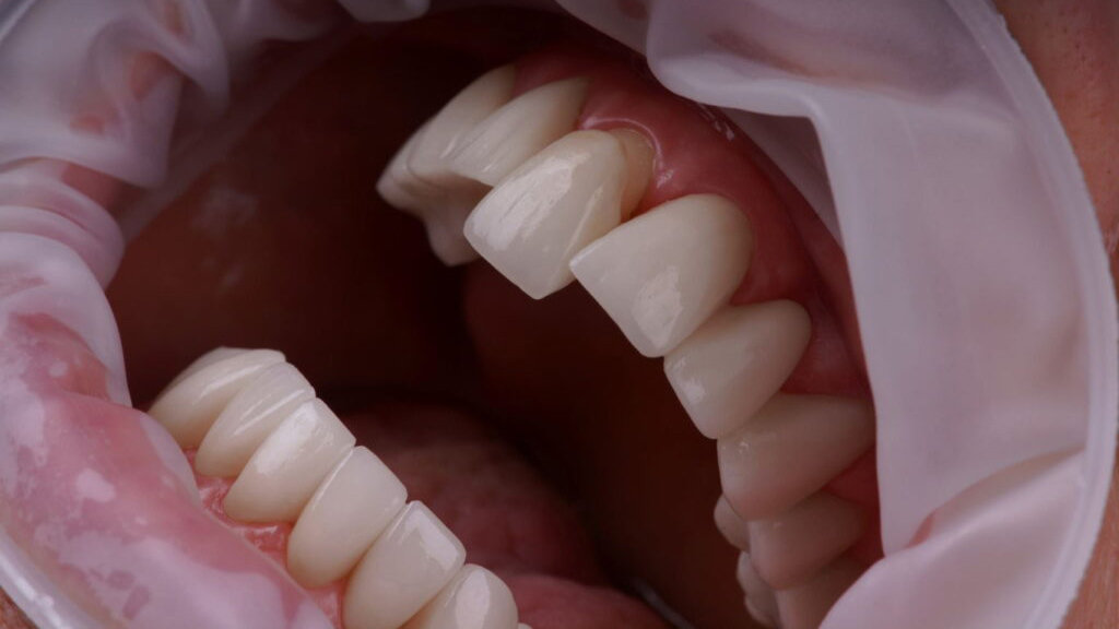 How much are Veneers in Turkey?